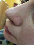 Пирсинг носа, шрам фото 2