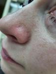 Пирсинг носа, шрам фото 1
