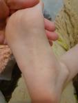 Высыпагия на ногах у ребенка фото 5