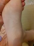 Высыпагия на ногах у ребенка фото 2