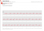 Кардиограмма после приступа фото 1