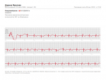 Кардиограмма после приступа фото 2