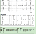 Холтеровское мониторирование заключение фото 5