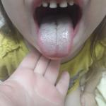 Белый налет на языке у ребёнка фото 2