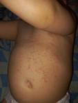 Непонятная сыпь у ребенка без температуры фото 1