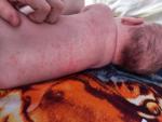 Сыпь на теле и лице у ребёнка 1 месяц и 10 дней фото 5