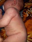 Сыпь на теле и лице у ребёнка 1 месяц и 10 дней фото 4