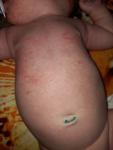 Сыпь на теле и лице у ребёнка 1 месяц и 10 дней фото 2