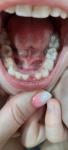 Кривой зуб у ребенка фото 1
