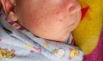 Сыпь на теле и лице у ребёнка 1 месяц и 10 дней фото 1