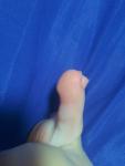 Воспаление на пальце ноги фото 5