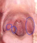 Странные точки в горле без симптомов, хотя почти закончила антибиотики фото 1