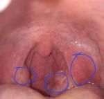 Странные точки в горле без симптомов, хотя почти закончила антибиотики фото 2