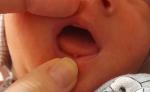 Белый нарост на кончике языка у новорожденного фото 3