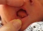 Белый нарост на кончике языка у новорожденного фото 2