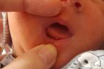 Белый нарост на кончике языка у новорожденного фото 1