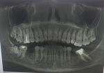 Сложное удаление зуба фото 1