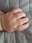Сыпь и покраснение на руках у ребёнка фото 3