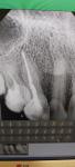 Зуб со штифтом под коронку фото 1