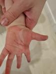 Сыпь и покраснение на руках у ребёнка фото 2