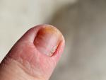 Воспаление ногтевого валика пальца руки фото 3