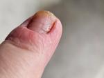 Воспаление ногтевого валика пальца руки фото 1