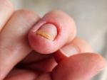 Воспаление ногтевого валика пальца руки фото 4