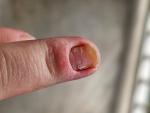 Воспаление ногтевого валика пальца руки фото 2