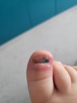 Воспаленный палец на ноге у двухлетки фото 3