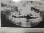 Удаление зуба мудрости при невропатии тройничного нерва фото 1