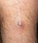 Воспаление ниже колена фото 1