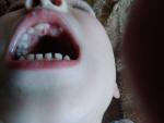 Зуб растет на нёбе( фото 3