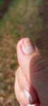 Покраснение лунки ногтя фото 2