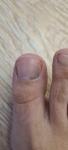 Подногтевая меланома? Пятно на ногте большого пальца ноги фото 2