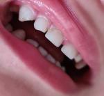 Белые пятна на зубах фото 3