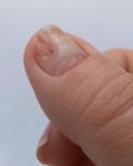 Покраснение лунки ногтя фото 4