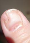 Покраснение лунки ногтя фото 5