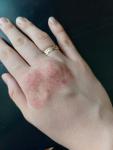 Как лечить дерматит на руке? фото 2