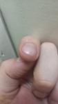 Болит около ногтя фото 3
