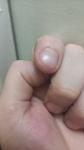 Болит около ногтя фото 5