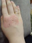 Как лечить дерматит на руке? фото 1