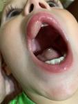 Опухла губа у ребёнка фото 2