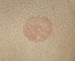 Круглое, розовое пятно на груди фото 1