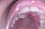 Дополнительный зуб фото 2