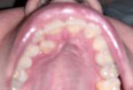 Дополнительный зуб фото 1