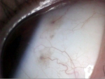 Чёрные точки на сосудаз глазного яблока фото 5