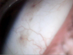 Чёрные точки на сосудаз глазного яблока фото 1