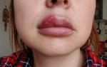 Увелечение губ фото 1