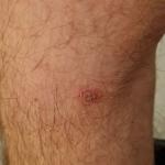 Красное пятно на ноге, чешется фото 1