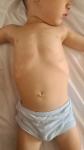 Деформация грудной клетки 3 года фото 3